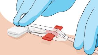 MasterGuard Apheresis Needle Removal Video [upl. by Atirahc]