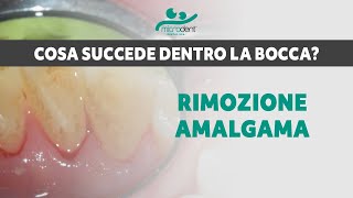 Rimozione Amalgama OTTURAZIONE IN COMPOSITO  Microdent Dental SPA Bologna [upl. by Arihk]