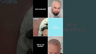 SMP is the answer scalpmicropigmentation bald hair scalpmicro [upl. by Heyer]