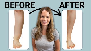 The Best Leg Lymphedema Treatment [upl. by Aihsinat]