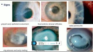 interstitial keratitis cogan syndrome acanthamoeba keratitis [upl. by Aisenat383]