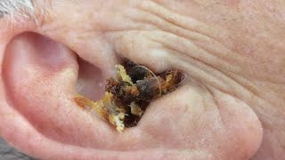 Ear Wax Removal Ear Wax Cleaning [upl. by Wells]