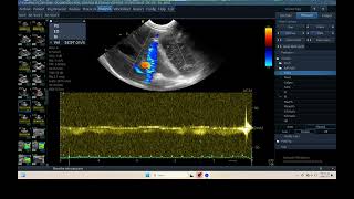 IQ 304 IVER DOPPLER ULTRASOUND ECHOPAC ANALYSIS 4 [upl. by Nepean224]