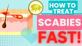 HOW TO TREAT SCABIES FAST TREATMENT AND HOME REMEDIES [upl. by Ahsilrak]