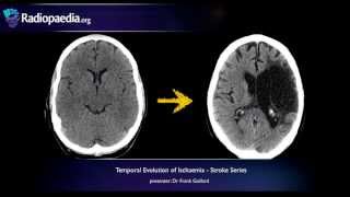 Stroke Evolution from acute to chronic infarction  radiology video tutorial CT MRI [upl. by Ad]