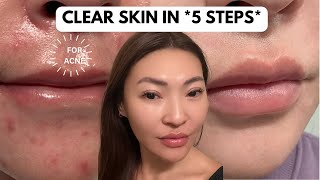 5 Step Acne Skincare Routine AM amp PM  How I Got Rid of Acne Scars Texture 2024 [upl. by Nemsaj]