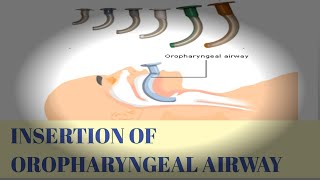 INSERTION OF OROPHARYNGEAL AIRWAYGUEDEL AIRWAY [upl. by Nilyak]