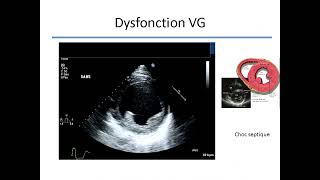 JLARMU 2021 Echographie cardiaque en anesthésie réanimation [upl. by Crespi]