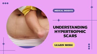 Hypertrophic Scar EXPERT Shares Shocking Truth [upl. by Esinaej366]