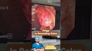 Colonoscopy for early Detection of coloncancer [upl. by Eednyl]