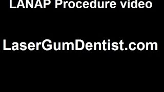 LANAP Failure Invisalign before and after periodontal Surgery GTR [upl. by Chemarin]