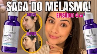 Testando o MELA B3 da La Roche Resultados em 14 Dias  Saga do Melasma Ep 4 [upl. by Aileda]