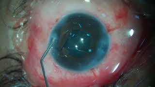 Fibrosed pupil Phaco with IOL using iris hooks 12 08 2023 Part 2 [upl. by Dael394]