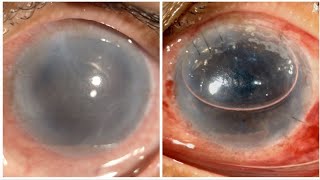 Pre Descemets Endothelial Keratoplasty PDEK and Single Pass 4 throw pupilloplasty SFT in PBK [upl. by Ravahs]