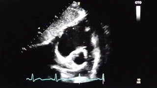 DextroKardiogramm in subcostalem Blick Subcostal shortaxis view SAX [upl. by Enwad]