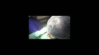 Sistrunk Surgery for Thyroglossal cyst [upl. by Patricio]