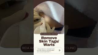 Removing Skin Tag [upl. by Orling]