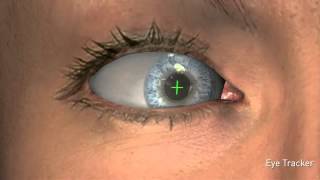 Do I Have To Keep My Eye Still During LASIK Surgery [upl. by Mcgean]