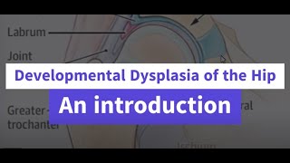 Developmental Dysplasia of the Hip an introduction [upl. by Aggy467]