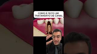 Como é feito um tratamento de canal odonto tratamentodecanal endodontia [upl. by Nitnelav98]