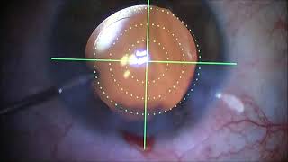 Implantation of Intraocular Lens Vivity XWave technology [upl. by Dwaine]