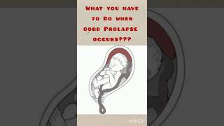 Obstetric Emergency Cord ProlapseManagement of cord prolapse [upl. by Eneleoj548]