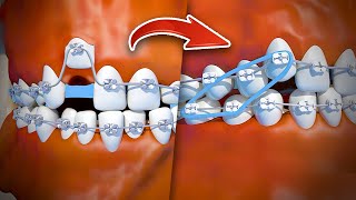 How braces are put on  Step by step [upl. by Rockafellow]