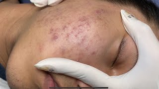 ACNE TREATMENT VU QUYNH MI  Blackheads On Boy Face 2024FULL [upl. by Oirrad327]