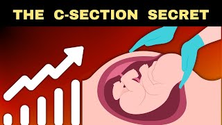 The Truth About Rising CSections  Cesarean Births [upl. by Letti]