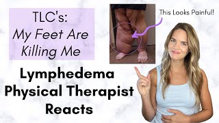 Lymphedema Physical Therapist Reacts Severe Leg Lymphedema  My Feet are Killing Me [upl. by Turrell]