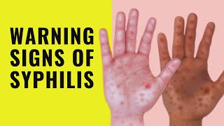 5 Symptoms of Syphilis  Early Signs and symptoms of syphilis  Syphilis [upl. by Noswal138]