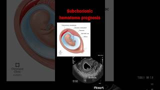 Subchorionic hematoma prognosis  Miscarriage rate following vaginal bleeding in pregnancy [upl. by Maddocks]