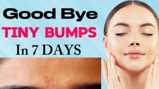 7 Days challenge Clear Tiny Bumps From Forehead amp cheek 100 Results  MinalHomeTips [upl. by Eyaf974]