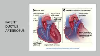 Congenital Heart Disease Lecture Series Ductal Dependent Lesions [upl. by Bergren]