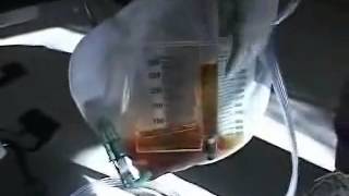 Foley Catheter Tubing and Collection Bag Free Nursing Video Lecture [upl. by Gilleod]