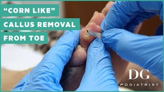 quotCorn likequot callus removal from toe [upl. by Elie]