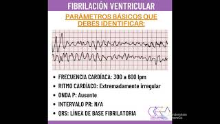 Fibrilación ventricular explicado en 1 minuto [upl. by Joub]