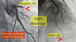 What is proximal and Distal LAD artery Blockage and Treatment l हार्ट ब्लॉकेज और ईलाज [upl. by Anerda]