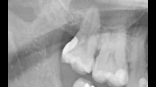 Nonsurgical treatment for distal subgingival caries in the upper right second molar [upl. by Yesnyl]