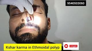 Ethmoidal polyp kshar removal [upl. by Ammadis]