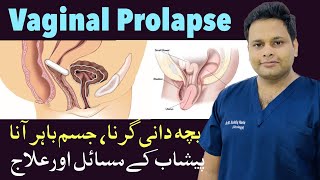 Vaginal Prolapse  Cystocele  Bacha Dani Ka Jism Se Baher Aana  Bacha Dani Gir jana [upl. by Cyn]