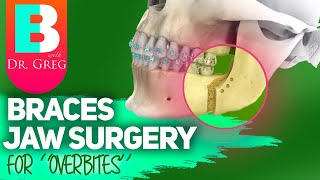 Braces Jaw Surgery for Overbite Correction Overjet Correction [upl. by Zzaj]