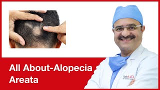 All AboutAlopecia Areata  HairMD Pune [upl. by Notslah]