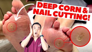 SUPER SATISFYING TRIPLE DEEP CORN REMOVAL amp THICK NAIL CUTTING  Dr Kim Kim Foot and Ankle [upl. by Corbet]