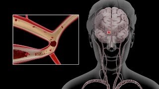 Carotid Dissection [upl. by Rainwater]