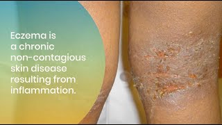 Treating and Managing Eczema in All Skin of Colors [upl. by Gut898]