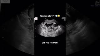 Guess the gender  fart in womb pregnancy pregnancycare ultrasound [upl. by Ardelia]