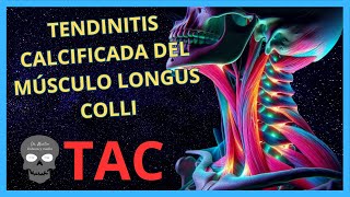 TENDINITIS Calcificada del Músculo LONGUS COLLI en TOMOGRAFÍA [upl. by Doner]