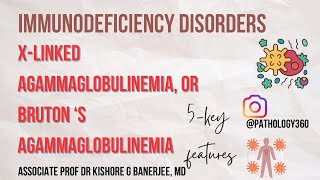 Immunodeficiency disorder  XLinked Hypogammaglobulinemia XLA or BRUTON’S Hypogammaglobulinemia [upl. by Zulch]