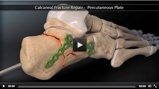 Calcaneal Fracture Percutaneous Plate [upl. by Ahsiral]